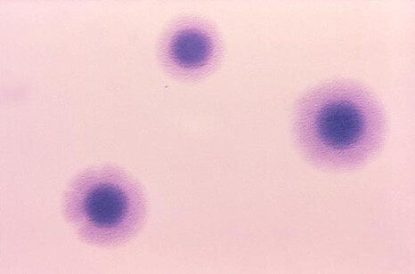 Ureaplasma bacteria shown in pink and purple.